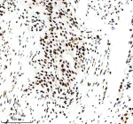 IHC analysis of Histone H3 (acetyl K14) using anti-Histone H3 (acetyl K14) antibody. Histone H3 (acetyl K14) was detected in a paraffin-embedded section of human bladder cancer tissue. Heat mediated antigen retrieval was performed in EDTA buffer (pH 8.0, epitope retrieval solution). The tissue section was blocked with 10% goat serum. The tissue section was then incubated with a dilution of 1:50 rabbit anti-Histone H3 (acetyl K14) antibody overnight at 4oC. Peroxidase Conjugated Goat Anti-rabbit IgG was used as secondary antibody and incubated for 30 minutes at 37oC. The tissue section was developed using an HRP secondary and DAB substrate.