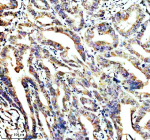 IHC staining of STOML2 using anti-STOML2 antibody. STOML2 was detected in a paraffin-embedded section of human colon cancer tissue. Heat mediated antigen retrieval was performed in EDTA buffer (pH 8.0, epitope retrieval solution). The tissue section was blocked with 10% goat serum. The tissue section was then incubated with 2 ug/ml rabbit anti-STOML2 antibody overnight at 4oC. Peroxidase Conjugated Goat Anti-rabbit IgG was used as secondary antibody and incubated for 30 minutes at 37oC. The tissue section was developed using an HRP secondary and DAB substrate.