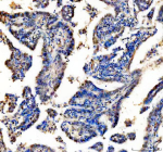 IHC analysis of RAD51D using anti-RAD51D antibody. RAD51D was detected in a paraffin-embedded section of human lung cancer tissue. Heat mediated antigen retrieval was performed in EDTA buffer (pH 8.0, epitope retrieval solution). The tissue section was blocked with 10% goat serum. The tissue section was then incubated with 2 ug/ml rabbit anti-RAD51D antibody overnight at 4oC. Peroxidase Conjugated Goat Anti-rabbit IgG was used as secondary antibody and incubated for 30 minutes at 37oC. The tissue section was developed using an HRP secondary and DAB substrate.