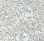 IHC analysis of HNRNPM using anti-HNRNPM antibody. HNRNPM was detected in a paraffin-embedded section of human stomach cancer tissue. Heat mediated antigen retrieval was performed in EDTA buffer (pH 8.0, epitope retrieval solution). The tissue section was blocked with 10% goat serum. The tissue section was then incubated with 1:50 rabbit anti-HNRNPM antibody overnight at 4oC. Peroxidase Conjugated Goat Anti-rabbit IgG was used as secondary antibody and incubated for 30 minutes at 37oC. The tissue section was developed using an HRP secondary and DAB substrate.