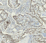 IHC analysis of HNRNPM using anti-HNRNPM antibody. HNRNPM was detected in a paraffin-embedded section of human rectal cancer tissue. Heat mediated antigen retrieval was performed in EDTA buffer (pH 8.0, epitope retrieval solution). The tissue section was blocked with 10% goat serum. The tissue section was then incubated with 1:50 rabbit anti-HNRNPM antibody overnight at 4oC. Peroxidase Conjugated Goat Anti-rabbit IgG was used as secondary antibody and incubated for 30 minutes at 37oC. The tissue section was developed using an HRP secondary and DAB substrate.