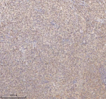 IHC analysis of SSX2IP using anti-SSX2IP antibody. SSX2IP was detected in a paraffin-embedded section of human cervix squamous cell carcinoma tissue. Heat mediated antigen retrieval was performed in EDTA buffer (pH 8.0, epitope retrieval solution). The tissue section was blocked with 10% goat serum. The tissue section was then incubated with 2 ug/ml rabbit anti-SSX2IP antibody overnight at 4oC. Peroxidase Conjugated Goat Anti-rabbit IgG was used as secondary antibody and incubated for 30 minutes at 37oC. The tissue section was developed using an HRP secondary and DAB substrate.