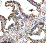 IHC analysis of PAM using anti-PAM antibody. PAM was detected in a paraffin-embedded section of human prostate cancer tissue. Heat mediated antigen retrieval was performed in EDTA buffer (pH 8.0, epitope retrieval solution). The tissue section was blocked with 10% goat serum. The tissue section was then incubated with 2 ug/ml rabbit anti-PAM antibody overnight at 4oC. Peroxidase Conjugated Goat Anti-rabbit IgG was used as secondary antibody and incubated for 30 minutes at 37oC. The tissue section was developed using an HRP secondary and DAB substrate.