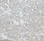 IHC analysis of IRF2BPL using anti-IRF2BPL antibody. IRF2BPL was detected in a paraffin-embedded section of follicles of human thyroid cancer tissue. Heat mediated antigen retrieval was performed in EDTA buffer (pH 8.0, epitope retrieval solution). The tissue section was blocked with 10% goat serum. The tissue section was then incubated with 2 ug/ml rabbit anti-IRF2BPL antibody overnight at 4oC. Peroxidase Conjugated Goat Anti-rabbit IgG was used as secondary antibody and incubated for 30 minutes at 37oC. The tissue section was developed using an HRP secondary and DAB substrate.