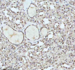 IHC analysis of IRF2BPL using anti-IRF2BPL antibody. IRF2BPL was detected in a paraffin-embedded section of follicles of human thyroid cancer tissue. Heat mediated antigen retrieval was performed in EDTA buffer (pH 8.0, epitope retrieval solution). The tissue section was blocked with 10% goat serum. The tissue section was then incubated with 2 ug/ml rabbit anti-IRF2BPL antibody overnight at 4oC. Peroxidase Conjugated Goat Anti-rabbit IgG was used as secondary antibody and incubated for 30 minutes at 37oC. The tissue section was developed using an HRP secondary and DAB substrate.