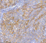 Immunohistochemical staining of TNIK using anti-TNIK antibody. TNIK was detected in a paraffin-embedded section of human cervix squamous cell carcinoma tissue. Heat mediated antigen retrieval was performed in EDTA buffer (pH 8.0, epitope retrieval solution). The tissue section was blocked with 10% goat serum. The tissue section was then incubated with 2 ug/ml rabbit anti-TNIK antibody overnight at 4oC. Peroxidase Conjugated Goat Anti-rabbit IgG was used as secondary antibody and incubated for 30 minutes at 37oC. The tissue section was developed using an HRP secondary and DAB substrate.