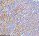 Immunohistochemical staining of TNIK using anti-TNIK antibody. TNIK was detected in a paraffin-embedded section of human cervix squamous cell carcinoma tissue. Heat mediated antigen retrieval was performed in EDTA buffer (pH 8.0, epitope retrieval solution). The tissue section was blocked with 10% goat serum. The tissue section was then incubated with 2 ug/ml rabbit anti-TNIK antibody overnight at 4oC. Peroxidase Conjugated Goat Anti-rabbit IgG was used as secondary antibody and incubated for 30 minutes at 37oC. The tissue section was developed using an HRP secondary and DAB substrate.