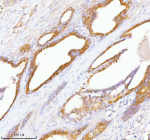 Immunohistochemical staining of TNIK using anti-TNIK antibody. TNIK was detected in a paraffin-embedded section of human prostate adenocarcinoma tissue. Heat mediated antigen retrieval was performed in EDTA buffer (pH 8.0, epitope retrieval solution). The tissue section was blocked with 10% goat serum. The tissue section was then incubated with 2 ug/ml rabbit anti-TNIK antibody overnight at 4oC. Peroxidase Conjugated Goat Anti-rabbit IgG was used as secondary antibody and incubated for 30 minutes at 37oC. The tissue section was developed using an HRP secondary and DAB substrate.
