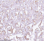 Immunohistochemical staining of TNIK using anti-TNIK antibody. TNIK was detected in a paraffin-embedded section of human prostate adenocarcinoma tissue. Heat mediated antigen retrieval was performed in EDTA buffer (pH 8.0, epitope retrieval solution). The tissue section was blocked with 10% goat serum. The tissue section was then incubated with 2 ug/ml rabbit anti-TNIK antibody overnight at 4oC. Peroxidase Conjugated Goat Anti-rabbit IgG was used as secondary antibody and incubated for 30 minutes at 37oC. The tissue section was developed using an HRP secondary and DAB substrate.