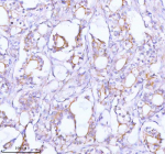 Immunohistochemical staining of TNIK using anti-TNIK antibody. TNIK was detected in a paraffin-embedded section of human prostate adenocarcinoma tissue. Heat mediated antigen retrieval was performed in EDTA buffer (pH 8.0, epitope retrieval solution). The tissue section was blocked with 10% goat serum. The tissue section was then incubated with 2 ug/ml rabbit anti-TNIK antibody overnight at 4oC. Peroxidase Conjugated Goat Anti-rabbit IgG was used as secondary antibody and incubated for 30 minutes at 37oC. The tissue section was developed using an HRP secondary and DAB substrate.