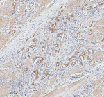 Immunohistochemical staining of TNIK using anti-TNIK antibody. TNIK was detected in a paraffin-embedded section of human prostate adenocarcinoma tissue. Heat mediated antigen retrieval was performed in EDTA buffer (pH 8.0, epitope retrieval solution). The tissue section was blocked with 10% goat serum. The tissue section was then incubated with 2 ug/ml rabbit anti-TNIK antibody overnight at 4oC. Peroxidase Conjugated Goat Anti-rabbit IgG was used as secondary antibody and incubated for 30 minutes at 37oC. The tissue section was developed using an HRP secondary and DAB substrate.