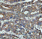 Immunohistochemical staining of PLIN5 using anti-PLIN5 antibody. PLIN5 was detected in a paraffin-embedded section of human stomach cancer tissue. Heat mediated antigen retrieval was performed in EDTA buffer (pH 8.0, epitope retrieval solution). The tissue section was blocked with 10% goat serum. The tissue section was then incubated with 2 ug/ml rabbit anti-PLIN5 antibody overnight at 4oC. Peroxidase Conjugated Goat Anti-rabbit IgG was used as secondary antibody and incubated for 30 minutes at 37oC. The tissue section was developed using an HRP secondary and DAB substrate.