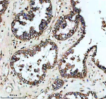 Immunohistochemical staining of PLIN5 using anti-PLIN5 antibody. PLIN5 was detected in a paraffin-embedded section of human ovarian cancer tissue. Heat mediated antigen retrieval was performed in EDTA buffer (pH 8.0, epitope retrieval solution). The tissue section was blocked with 10% goat serum. The tissue section was then incubated with 2 ug/ml rabbit anti-PLIN5 antibody overnight at 4oC. Peroxidase Conjugated Goat Anti-rabbit IgG was used as secondary antibody and incubated for 30 minutes at 37oC. The tissue section was developed using an HRP secondary and DAB substrate.