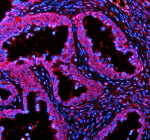 Immunofluorescent staining of PLIN5 using anti-PLIN5 antibody (red). PLIN5 was detected in a paraffin-embedded section of human ovarian cancer tissue. Heat mediated antigen retrieval was performed in EDTA buffer (pH 8.0, epitope retrieval solution). The tissue section was blocked with 10% goat serum. The tissue section was then incubated with 5 ug/ml rabbit anti-PLIN5 antibody overnight at 4oC. Cy3 Conjugated Goat Anti-Rabbit IgG was used as secondary antibody at 1:500 dilution and incubated for 30 minutes at 37oC. The section was counterstained with DAPI nuclear stain (blue). Visualize using a fluorescence microscope and filter sets appropriate for the label used.