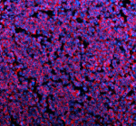Immunofluorescent staining of PLIN5 using anti-PLIN5 antibody (red). PLIN5 was detected in a paraffin-embedded section of human stomach cancer tissue. Heat mediated antigen retrieval was performed in EDTA buffer (pH 8.0, epitope retrieval solution). The tissue section was blocked with 10% goat serum. The tissue section was then incubated with 5 ug/ml rabbit anti-PLIN5 antibody overnight at 4oC. Cy3 Conjugated Goat Anti-Rabbit IgG was used as secondary antibody at 1:500 dilution and incubated for 30 minutes at 37oC. The section was counterstained with DAPI nuclear stain (blue). Visualize using a fluorescence microscope and filter sets appropriate for the label used.