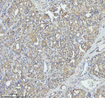 Immunohistochemical staining of TOM1 using anti-TOM1 antibody. TOM1 was detected in a paraffin-embedded section of human thyroid cancer tissue. Heat mediated antigen retrieval was performed in EDTA buffer (pH 8.0, epitope retrieval solution). The tissue section was blocked with 10% goat serum. The tissue section was then incubated with 2 ug/ml rabbit anti-TOM1 antibody overnight at 4oC. Peroxidase Conjugated Goat Anti-rabbit IgG was used as secondary antibody and incubated for 30 minutes at 37oC. The tissue section was developed using an HRP secondary and DAB substrate.