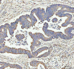 Immunohistochemical staining of ARHGEF12L using anti-ARHGEF12L antibody. ARHGEF12L was detected in a paraffin-embedded section of human colorectal adenocarcinoma tissue. Heat mediated antigen retrieval was performed in EDTA buffer (pH 8.0, epitope retrieval solution). The tissue section was blocked with 10% goat serum. The tissue section was then incubated with 2 ug/ml rabbit anti-ARHGEF12L antibody overnight at 4oC. Peroxidase Conjugated Goat Anti-rabbit IgG was used as secondary antibody and incubated for 30 minutes at 37oC. The tissue section was developed using an HRP secondary and DAB substrate.