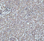 Immunohistochemical staining of ARHGEF12L using anti-ARHGEF12L antibody. ARHGEF12L was detected in a paraffin-embedded section of human parotid acinar cell carcinoma tissue. Heat mediated antigen retrieval was performed in EDTA buffer (pH 8.0, epitope retrieval solution). The tissue section was blocked with 10% goat serum. The tissue section was then incubated with 2 ug/ml rabbit anti-ARHGEF12L antibody overnight at 4oC. Peroxidase Conjugated Goat Anti-rabbit IgG was used as secondary antibody and incubated for 30 minutes at 37oC. The tissue section was developed using an HRP secondary and DAB substrate.
