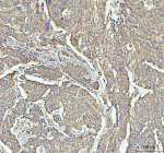 Immunohistochemical staining of ARHGEF12L using anti-ARHGEF12L antibody. ARHGEF12L was detected in a paraffin-embedded section of human squamous cell carcinoma of cervix tissue. Heat mediated antigen retrieval was performed in EDTA buffer (pH 8.0, epitope retrieval solution). The tissue section was blocked with 10% goat serum. The tissue section was then incubated with 2 ug/ml rabbit anti-ARHGEF12L antibody overnight at 4oC. Peroxidase Conjugated Goat Anti-rabbit IgG was used as secondary antibody and incubated for 30 minutes at 37oC. The tissue section was developed using an HRP secondary and DAB substrate.