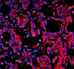 Immunofluorescent staining of SORL1 using anti-SORL1 antibody (red). SORL1 was detected in a paraffin-embedded section of human breast cancer tissue. Heat mediated antigen retrieval was performed in EDTA buffer (pH 8.0, epitope retrieval solution). The tissue section was blocked with 10% goat serum. The tissue section was then incubated with 5 ug/ml rabbit anti-SORL1 antibody overnight at 4oC. Cy3 Conjugated Goat Anti-Rabbit IgG was used as secondary antibody at 1:500 dilution and incubated for 30 minutes at 37oC. The section was counterstained with DAPI nuclear stain (blue). Visualize using a fluorescence microscope and filter sets appropriate for the label used.