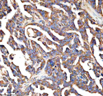 Immunohistochemical staining of PALS1 using anti-PALS1 antibody. PALS1 was detected in a paraffin-embedded section of human ovarian cancer tissue. Heat mediated antigen retrieval was performed in EDTA buffer (pH 8.0, epitope retrieval solution). The tissue section was blocked with 10% goat serum. The tissue section was then incubated with 2 ug/ml rabbit anti-PALS1 antibody overnight at 4oC. Peroxidase Conjugated Goat Anti-rabbit IgG was used as secondary antibody and incubated for 30 minutes at 37oC. The tissue section was developed using an HRP secondary and DAB substrate.