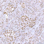 Immunohistochemical staining of SRRT using anti-SRRT antibody. SRRT was detected in a paraffin-embedded section of human appendix adenocarcinoma tissue. Heat mediated antigen retrieval was performed in EDTA buffer (pH 8.0, epitope retrieval solution). The tissue section was blocked with 10% goat serum. The tissue section was then incubated with 2 ug/ml rabbit anti-SRRT antibody overnight at 4oC. Peroxidase Conjugated Goat Anti-rabbit IgG was used as secondary antibody and incubated for 30 minutes at 37oC. The tissue section was developed using an HRP secondary and DAB substrate.