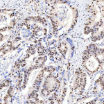 Immunohistochemical staining of SRRT using anti-SRRT antibody. SRRT was detected in a paraffin-embedded section of human lung adenocarcinoma tissue. Heat mediated antigen retrieval was performed in EDTA buffer (pH 8.0, epitope retrieval solution). The tissue section was blocked with 10% goat serum. The tissue section was then incubated with 2 ug/ml rabbit anti-SRRT antibody overnight at 4oC. Peroxidase Conjugated Goat Anti-rabbit IgG was used as secondary antibody and incubated for 30 minutes at 37oC. The tissue section was developed using an HRP secondary and DAB substrate.