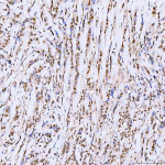 Immunohistochemical staining of SRRT using anti-SRRT antibody. SRRT was detected in a paraffin-embedded section of human breast cancer tissue. Heat mediated antigen retrieval was performed in EDTA buffer (pH 8.0, epitope retrieval solution). The tissue section was blocked with 10% goat serum. The tissue section was then incubated with 2 ug/ml rabbit anti-SRRT antibody overnight at 4oC. Peroxidase Conjugated Goat Anti-rabbit IgG was used as secondary antibody and incubated for 30 minutes at 37oC. The tissue section was developed using an HRP secondary and DAB substrate.