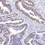 Immunohistochemical staining of SRRT using anti-SRRT antibody. SRRT was detected in a paraffin-embedded section of human endometrioid adenocarcinoma tissue. Heat mediated antigen retrieval was performed in EDTA buffer (pH 8.0, epitope retrieval solution). The tissue section was blocked with 10% goat serum. The tissue section was then incubated with 2 ug/ml rabbit anti-SRRT antibody overnight at 4oC. Peroxidase Conjugated Goat Anti-rabbit IgG was used as secondary antibody and incubated for 30 minutes at 37oC. The tissue section was developed using an HRP secondary and DAB substrate.
