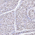Immunohistochemical staining of SRRT using anti-SRRT antibody. SRRT was detected in a paraffin-embedded section of human liver cancer tissue. Heat mediated antigen retrieval was performed in EDTA buffer (pH 8.0, epitope retrieval solution). The tissue section was blocked with 10% goat serum. The tissue section was then incubated with 2 ug/ml rabbit anti-SRRT antibody overnight at 4oC. Peroxidase Conjugated Goat Anti-rabbit IgG was used as secondary antibody and incubated for 30 minutes at 37oC. The tissue section was developed using an HRP secondary and DAB substrate.
