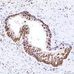 Immunohistochemical staining of SRRT using anti-SRRT antibody. SRRT was detected in a paraffin-embedded section of human colon adenocarcinoma tissue. Heat mediated antigen retrieval was performed in EDTA buffer (pH 8.0, epitope retrieval solution). The tissue section was blocked with 10% goat serum. The tissue section was then incubated with 2 ug/ml rabbit anti-SRRT antibody overnight at 4oC. Peroxidase Conjugated Goat Anti-rabbit IgG was used as secondary antibody and incubated for 30 minutes at 37oC. The tissue section was developed using an HRP secondary and DAB substrate.