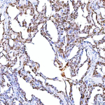 Immunohistochemical staining of SRRT using anti-SRRT antibody. SRRT was detected in a paraffin-embedded section of human ovary serous carcinoma tissue. Heat mediated antigen retrieval was performed in EDTA buffer (pH 8.0, epitope retrieval solution). The tissue section was blocked with 10% goat serum. The tissue section was then incubated with 2 ug/ml rabbit anti-SRRT antibody overnight at 4oC. Peroxidase Conjugated Goat Anti-rabbit IgG was used as secondary antibody and incubated for 30 minutes at 37oC. The tissue section was developed using an HRP secondary and DAB substrate.