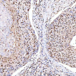 Immunohistochemical staining of SRRT using anti-SRRT antibody. SRRT was detected in a paraffin-embedded section of human penis squamous cell carcinoma tissue. Heat mediated antigen retrieval was performed in EDTA buffer (pH 8.0, epitope retrieval solution). The tissue section was blocked with 10% goat serum. The tissue section was then incubated with 2 ug/ml rabbit anti-SRRT antibody overnight at 4oC. Peroxidase Conjugated Goat Anti-rabbit IgG was used as secondary antibody and incubated for 30 minutes at 37oC. The tissue section was developed using an HRP secondary and DAB substrate.
