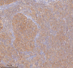 Immunohistochemical staining of RIGI using anti-RIGI antibody. RIGI was detected in a paraffin-embedded section of human cervix squamous cell carcinoma tissue. Heat mediated antigen retrieval was performed in EDTA buffer (pH 8.0, epitope retrieval solution). The tissue section was blocked with 10% goat serum. The tissue section was then incubated with 2 ug/ml rabbit anti-RIGI antibody overnight at 4oC. Peroxidase Conjugated Goat Anti-rabbit IgG was used as secondary antibody and incubated for 30 minutes at 37oC. The tissue section was developed using an HRP secondary and DAB substrate.