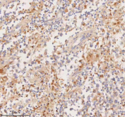 Immunohistochemical staining of RIGI using anti-RIGI antibody. RIGI was detected in a paraffin-embedded section of human testicular seminoma tissue. Heat mediated antigen retrieval was performed in EDTA buffer (pH 8.0, epitope retrieval solution). The tissue section was blocked with 10% goat serum. The tissue section was then incubated with 2 ug/ml rabbit anti-RIGI antibody overnight at 4oC. Peroxidase Conjugated Goat Anti-rabbit IgG was used as secondary antibody and incubated for 30 minutes at 37oC. The tissue section was developed using an HRP secondary and DAB substrate.