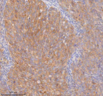 Immunohistochemical staining of RIGI using anti-RIGI antibody. RIGI was detected in a paraffin-embedded section of human cervix squamous cell carcinoma tissue. Heat mediated antigen retrieval was performed in EDTA buffer (pH 8.0, epitope retrieval solution). The tissue section was blocked with 10% goat serum. The tissue section was then incubated with 2 ug/ml rabbit anti-RIGI antibody overnight at 4oC. Peroxidase Conjugated Goat Anti-rabbit IgG was used as secondary antibody and incubated for 30 minutes at 37oC. The tissue section was developed using an HRP secondary and DAB substrate.
