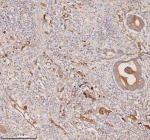 Immunohistochemical staining of RIGI using anti-RIGI antibody. RIGI was detected in a paraffin-embedded section of human rectum adenocarcinoma tissue. Heat mediated antigen retrieval was performed in EDTA buffer (pH 8.0, epitope retrieval solution). The tissue section was blocked with 10% goat serum. The tissue section was then incubated with 2 ug/ml rabbit anti-RIGI antibody overnight at 4oC. Peroxidase Conjugated Goat Anti-rabbit IgG was used as secondary antibody and incubated for 30 minutes at 37oC. The tissue section was developed using an HRP secondary and DAB substrate.