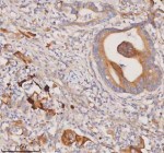 Immunohistochemical staining of RIGI using anti-RIGI antibody. RIGI was detected in a paraffin-embedded section of human rectum adenocarcinoma tissue. Heat mediated antigen retrieval was performed in EDTA buffer (pH 8.0, epitope retrieval solution). The tissue section was blocked with 10% goat serum. The tissue section was then incubated with 2 ug/ml rabbit anti-RIGI antibody overnight at 4oC. Peroxidase Conjugated Goat Anti-rabbit IgG was used as secondary antibody and incubated for 30 minutes at 37oC. The tissue section was developed using an HRP secondary and DAB substrate.