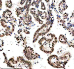 Immunohistochemical staining of Histone H3 (acetyl K9) using anti-Histone H3 (acetyl K9) antibody. Histone H3 (acetyl K9) was detected in a paraffin-embedded section of human lung cancer tissue. Heat mediated antigen retrieval was performed in EDTA buffer (pH 8.0, epitope retrieval solution). The tissue section was blocked with 10% goat serum. The tissue section was then incubated with a dilution of 1:50 rabbit anti-Histone H3 (acetyl K9) antibody overnight at 4oC. Peroxidase Conjugated Goat Anti-rabbit IgG was used as secondary antibody and incubated for 30 minutes at 37oC. The tissue section was developed using an HRP secondary and DAB substrate.