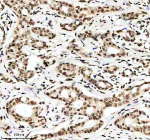 Immunohistochemical staining of Histone H3 (acetyl K9) using anti-Histone H3 (acetyl K9) antibody. Histone H3 (acetyl K9) was detected in a paraffin-embedded section of human breast cancer tissue. Heat mediated antigen retrieval was performed in EDTA buffer (pH 8.0, epitope retrieval solution). The tissue section was blocked with 10% goat serum. The tissue section was then incubated with a dilution of 1:50 rabbit anti-Histone H3 (acetyl K9) antibody overnight at 4oC. Peroxidase Conjugated Goat Anti-rabbit IgG was used as secondary antibody and incubated for 30 minutes at 37oC. The tissue section was developed using an HRP secondary and DAB substrate.