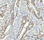 Immunohistochemical staining of FAM50A using anti-FAM50A antibody. FAM50A was detected in a paraffin-embedded section of human colorectal adenocarcinoma tissue. Heat mediated antigen retrieval was performed in EDTA buffer (pH 8.0, epitope retrieval solution). The tissue section was blocked with 10% goat serum. The tissue section was then incubated with 1:50 rabbit anti-FAM50A antibody overnight at 4oC. Peroxidase Conjugated Goat Anti-rabbit IgG was used as secondary antibody and incubated for 30 minutes at 37oC. The tissue section was developed using an HRP secondary and DAB substrate.