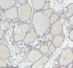 Immunohistochemical staining of FAM111B using anti-FAM111B antibody. FAM111B was detected in a paraffin-embedded section of follicles of human thyroid cancer tissue. Heat mediated antigen retrieval was performed in EDTA buffer (pH 8.0, epitope retrieval solution). The tissue section was blocked with 10% goat serum. The tissue section was then incubated with 2 ug/ml rabbit anti-FAM111B antibody overnight at 4oC. Peroxidase Conjugated Goat Anti-rabbit IgG was used as secondary antibody and incubated for 30 minutes at 37oC. The tissue section was developed using an HRP secondary and DAB substrate.