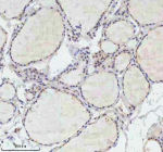 Immunohistochemical staining of FAM111B using anti-FAM111B antibody. FAM111B was detected in a paraffin-embedded section of follicles of human thyroid cancer tissue. Heat mediated antigen retrieval was performed in EDTA buffer (pH 8.0, epitope retrieval solution). The tissue section was blocked with 10% goat serum. The tissue section was then incubated with 2 ug/ml rabbit anti-FAM111B antibody overnight at 4oC. Peroxidase Conjugated Goat Anti-rabbit IgG was used as secondary antibody and incubated for 30 minutes at 37oC. The tissue section was developed using an HRP secondary and DAB substrate.
