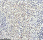 Immunohistochemical staining of FAM111B using anti-FAM111B antibody. FAM111B was detected in a paraffin-embedded section of human bladder cancer tissue. Heat mediated antigen retrieval was performed in EDTA buffer (pH 8.0, epitope retrieval solution). The tissue section was blocked with 10% goat serum. The tissue section was then incubated with 2 ug/ml rabbit anti-FAM111B antibody overnight at 4oC. Peroxidase Conjugated Goat Anti-rabbit IgG was used as secondary antibody and incubated for 30 minutes at 37oC. The tissue section was developed using an HRP secondary and DAB substrate.