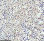 Immunohistochemical staining of FAM111B using anti-FAM111B antibody. FAM111B was detected in a paraffin-embedded section of human bladder cancer tissue. Heat mediated antigen retrieval was performed in EDTA buffer (pH 8.0, epitope retrieval solution). The tissue section was blocked with 10% goat serum. The tissue section was then incubated with 2 ug/ml rabbit anti-FAM111B antibody overnight at 4oC. Peroxidase Conjugated Goat Anti-rabbit IgG was used as secondary antibody and incubated for 30 minutes at 37oC. The tissue section was developed using an HRP secondary and DAB substrate.