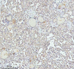 Immunohistochemical staining of FAM111B using anti-FAM111B antibody. FAM111B was detected in a paraffin-embedded section of human thyroid cancer tissue. Heat mediated antigen retrieval was performed in EDTA buffer (pH 8.0, epitope retrieval solution). The tissue section was blocked with 10% goat serum. The tissue section was then incubated with 2 ug/ml rabbit anti-FAM111B antibody overnight at 4oC. Peroxidase Conjugated Goat Anti-rabbit IgG was used as secondary antibody and incubated for 30 minutes at 37oC. The tissue section was developed using an HRP secondary and DAB substrate.