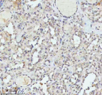 Immunohistochemical staining of FAM111B using anti-FAM111B antibody. FAM111B was detected in a paraffin-embedded section of human thyroid cancer tissue. Heat mediated antigen retrieval was performed in EDTA buffer (pH 8.0, epitope retrieval solution). The tissue section was blocked with 10% goat serum. The tissue section was then incubated with 2 ug/ml rabbit anti-FAM111B antibody overnight at 4oC. Peroxidase Conjugated Goat Anti-rabbit IgG was used as secondary antibody and incubated for 30 minutes at 37oC. The tissue section was developed using an HRP secondary and DAB substrate.
