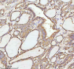 Immunohistochemical staining of NRTN using anti-NRTN antibody. NRTN was detected in a paraffin-embedded section of human thyroid papillary carcinoma tissue. Heat mediated antigen retrieval was performed in EDTA buffer (pH 8.0, epitope retrieval solution). The tissue section was blocked with 10% goat serum. The tissue section was then incubated with 2 ug/ml rabbit anti-NRTN antibody overnight at 4oC. Peroxidase Conjugated Goat Anti-rabbit IgG was used as secondary antibody and incubated for 30 minutes at 37oC. The tissue section was developed using an HRP secondary and DAB substrate.