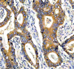 Immunohistochemical staining of PPP2R5E using anti-PPP2R5E antibody. PPP2R5E was detected in a paraffin-embedded section of human stomach cancer tissue. Heat mediated antigen retrieval was performed in EDTA buffer (pH 8.0, epitope retrieval solution). The tissue section was blocked with 10% goat serum. The tissue section was then incubated with 2 ug/ml rabbit anti-PPP2R5E antibody overnight at 4oC. Peroxidase Conjugated Goat Anti-rabbit IgG was used as secondary antibody and incubated for 30 minutes at 37oC. The tissue section was developed using an HRP secondary and DAB substrate.