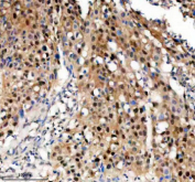 Immunohistochemical staining of TNFAIP2 using anti-TNFAIP2 antibody. TNFAIP2 was detected in a paraffin-embedded section of human bladder cancer tissue. Heat mediated antigen retrieval was performed in EDTA buffer (pH 8.0, epitope retrieval solution). The tissue section was blocked with 10% goat serum. The tissue section was then incubated with 2 ug/ml rabbit anti-TNFAIP2 antibody overnight at 4oC. Peroxidase Conjugated Goat Anti-rabbit IgG was used as secondary antibody and incubated for 30 minutes at 37oC. The tissue section was developed using an HRP secondary and DAB substrate.
